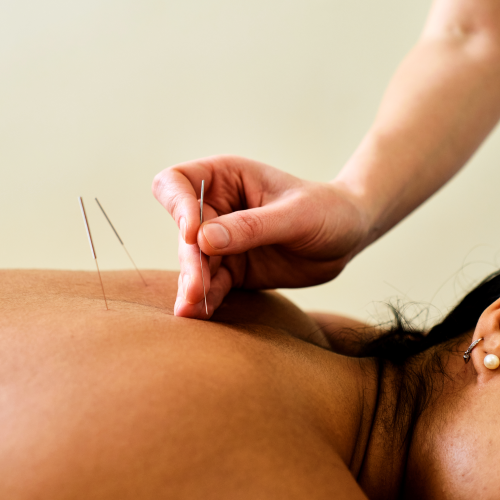 acupunture
